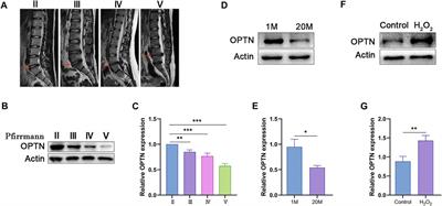 Optineurin-mediated mitophagy as a potential therapeutic target for intervertebral disc degeneration